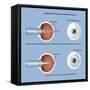 Astigmatism and Correction with Corrective Lens-null-Framed Stretched Canvas