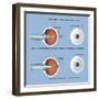 Astigmatism and Correction with Corrective Lens-null-Framed Art Print