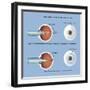 Astigmatism and Correction with Corrective Lens-null-Framed Art Print