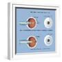 Astigmatism and Correction with Corrective Lens-null-Framed Art Print