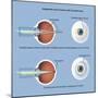 Astigmatism and Correction with Corrective Lens-null-Mounted Art Print