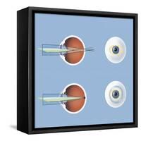 Astigmatism and Correction with Corrective Lens-null-Framed Stretched Canvas