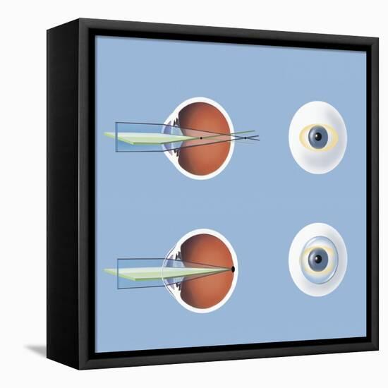 Astigmatism and Correction with Corrective Lens-null-Framed Stretched Canvas