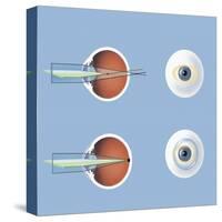 Astigmatism and Correction with Corrective Lens-null-Stretched Canvas