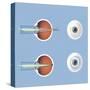 Astigmatism and Correction with Corrective Lens-null-Stretched Canvas