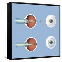 Astigmatism and Correction with Corrective Lens-null-Framed Stretched Canvas