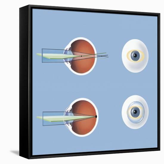 Astigmatism and Correction with Corrective Lens-null-Framed Stretched Canvas