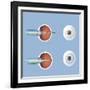 Astigmatism and Correction with Corrective Lens-null-Framed Art Print