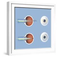 Astigmatism and Correction with Corrective Lens-null-Framed Art Print