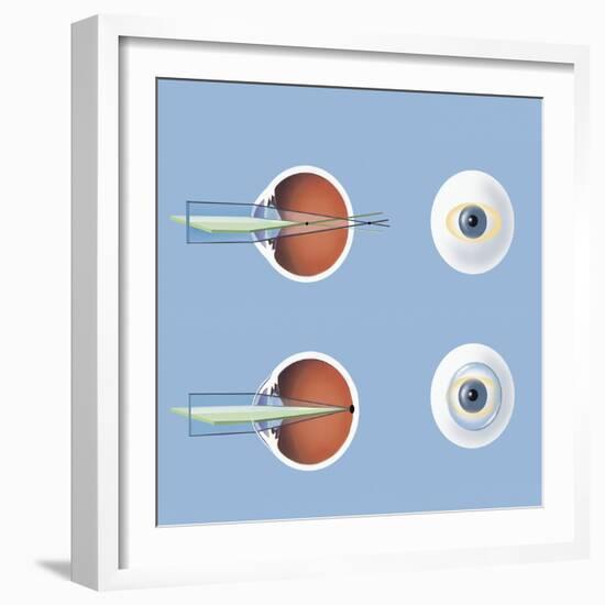 Astigmatism and Correction with Corrective Lens-null-Framed Art Print