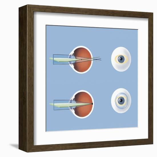 Astigmatism and Correction with Corrective Lens-null-Framed Art Print