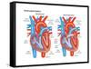 Atrial Septal Defect-Encyclopaedia Britannica-Framed Stretched Canvas