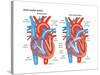 Atrial Septal Defect-Encyclopaedia Britannica-Stretched Canvas