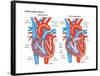 Atrial Septal Defect-Encyclopaedia Britannica-Framed Poster