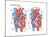 Atrial Septal Defect-Encyclopaedia Britannica-Mounted Poster