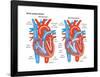 Atrial Septal Defect-Encyclopaedia Britannica-Framed Poster