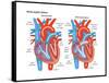 Atrial Septal Defect-Encyclopaedia Britannica-Framed Stretched Canvas