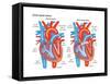 Atrial Septal Defect-Encyclopaedia Britannica-Framed Stretched Canvas