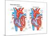 Atrial Septal Defect-Encyclopaedia Britannica-Mounted Poster