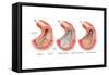 Balloon Angioplasty and Stent Insertion. Cardiovascular System, Health and Disease-Encyclopaedia Britannica-Framed Stretched Canvas