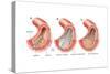 Balloon Angioplasty and Stent Insertion. Cardiovascular System, Health and Disease-Encyclopaedia Britannica-Stretched Canvas