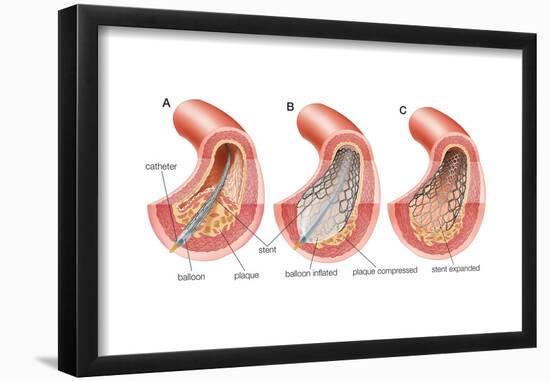 Balloon Angioplasty and Stent Insertion. Cardiovascular System, Health and Disease-Encyclopaedia Britannica-Framed Poster