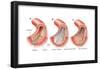 Balloon Angioplasty and Stent Insertion. Cardiovascular System, Health and Disease-Encyclopaedia Britannica-Framed Poster