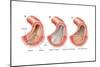 Balloon Angioplasty and Stent Insertion. Cardiovascular System, Health and Disease-Encyclopaedia Britannica-Mounted Poster