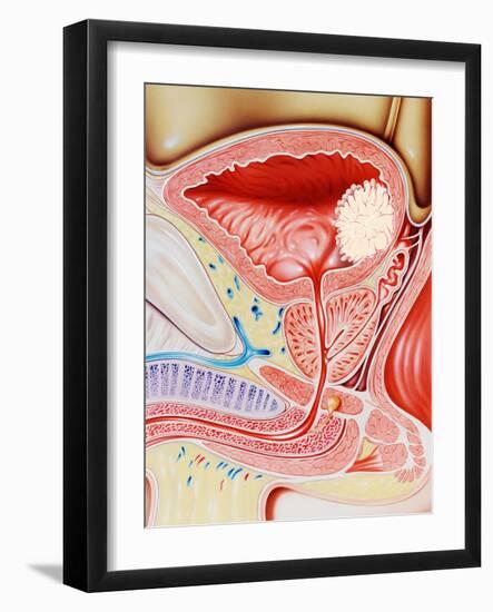 Bladder Cancer-John Bavosi-Framed Photographic Print