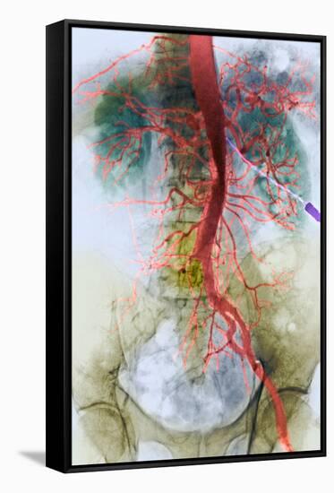 Blocked Artery, X-ray-null-Framed Stretched Canvas