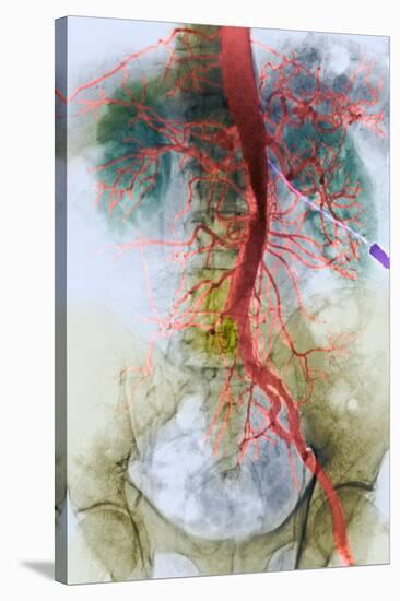 Blocked Artery, X-ray-null-Stretched Canvas