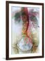 Blocked Artery, X-ray-null-Framed Photographic Print