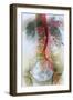 Blocked Artery, X-ray-null-Framed Photographic Print