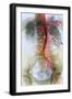 Blocked Artery, X-ray-null-Framed Photographic Print