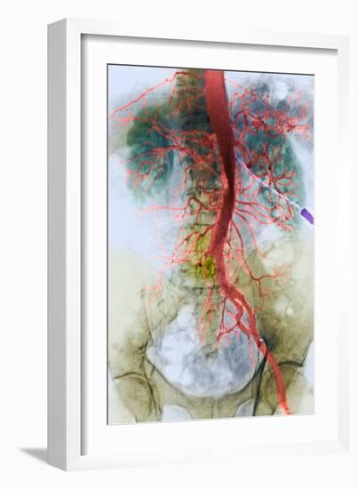 Blocked Artery, X-ray-null-Framed Photographic Print