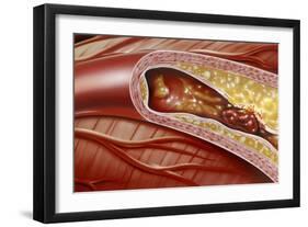 Blocked Coronary Artery, Artwork-John Bavosi-Framed Photographic Print