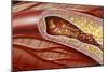 Blocked Coronary Artery, Artwork-John Bavosi-Mounted Photographic Print