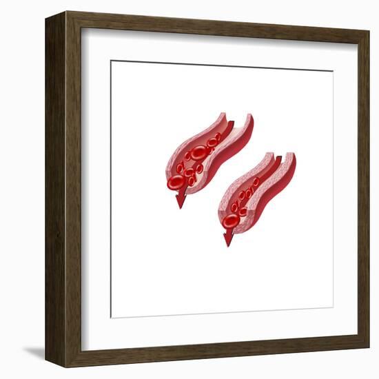 Blood Flow Through a Relaxed Artery Verus an Artery in Spasm-null-Framed Art Print