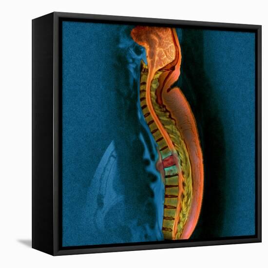 Bone Cancer, MRI-Du Cane Medical-Framed Stretched Canvas