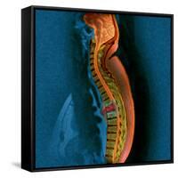 Bone Cancer, MRI-Du Cane Medical-Framed Stretched Canvas
