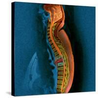 Bone Cancer, MRI-Du Cane Medical-Stretched Canvas