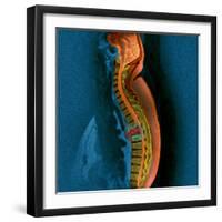 Bone Cancer, MRI-Du Cane Medical-Framed Premium Photographic Print