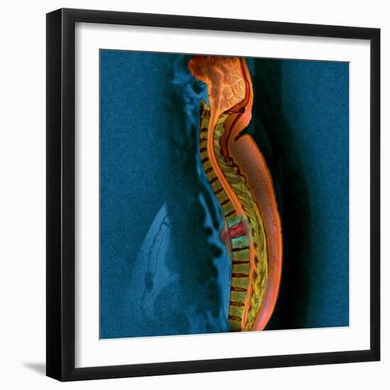 Bone Cancer, MRI-Du Cane Medical-Framed Premium Photographic Print