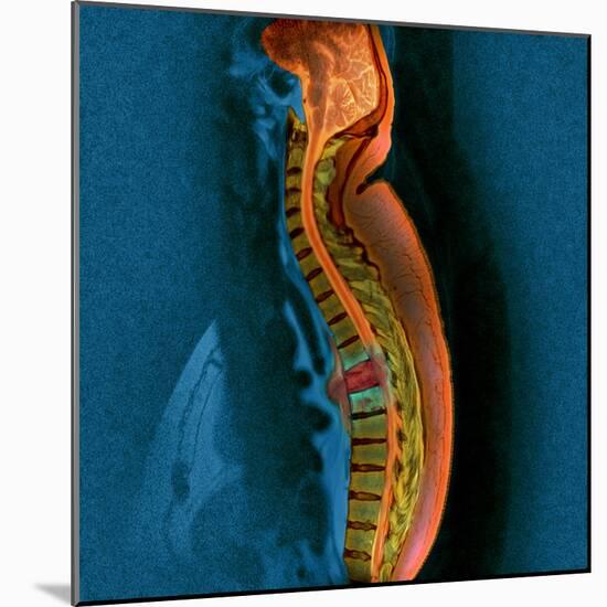 Bone Cancer, MRI-Du Cane Medical-Mounted Premium Photographic Print