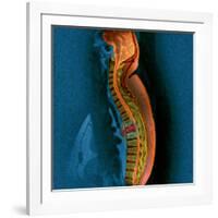 Bone Cancer, MRI-Du Cane Medical-Framed Photographic Print