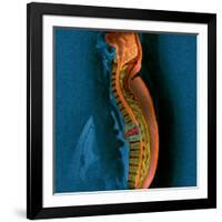 Bone Cancer, MRI-Du Cane Medical-Framed Photographic Print