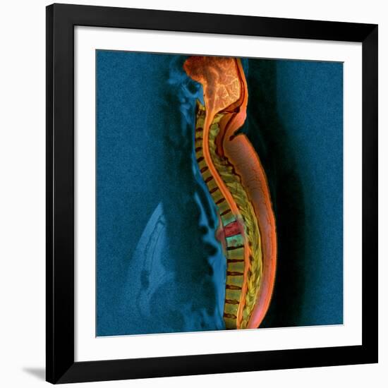 Bone Cancer, MRI-Du Cane Medical-Framed Photographic Print