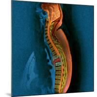 Bone Cancer, MRI-Du Cane Medical-Mounted Photographic Print