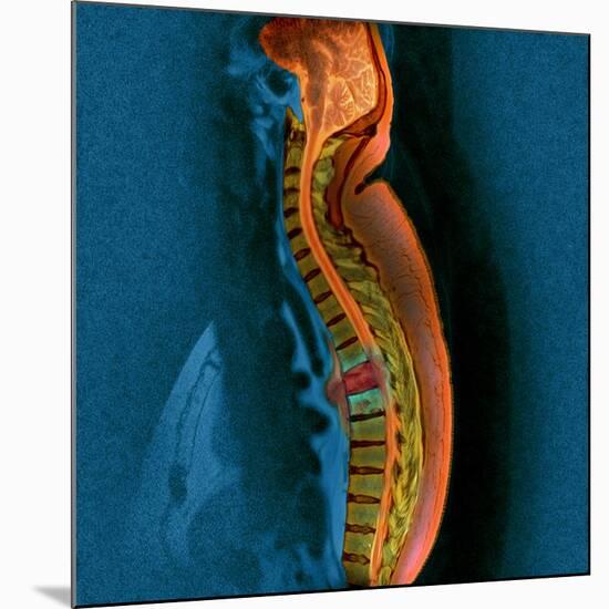 Bone Cancer, MRI-Du Cane Medical-Mounted Photographic Print