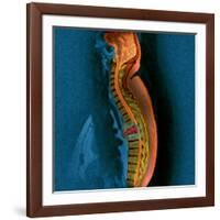 Bone Cancer, MRI-Du Cane Medical-Framed Photographic Print